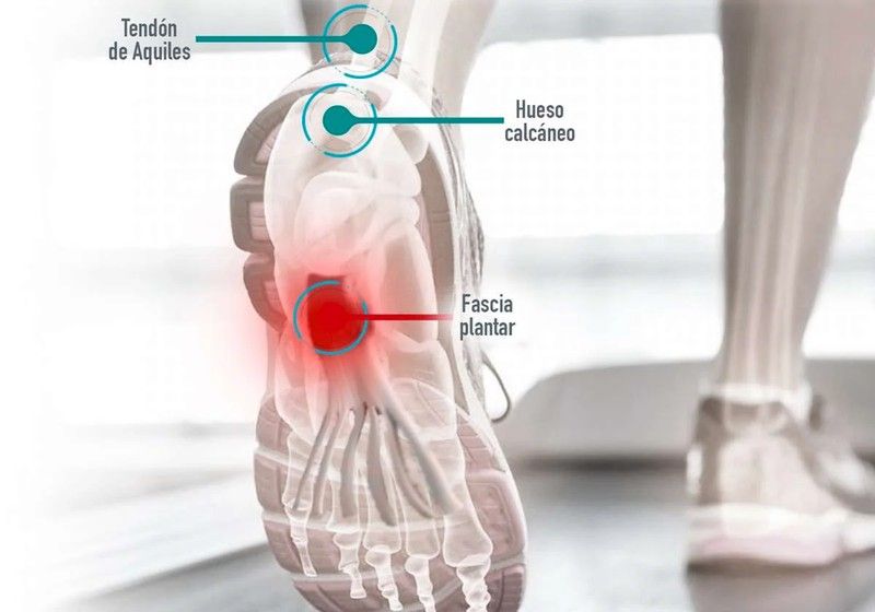 La Fascitis Plantar