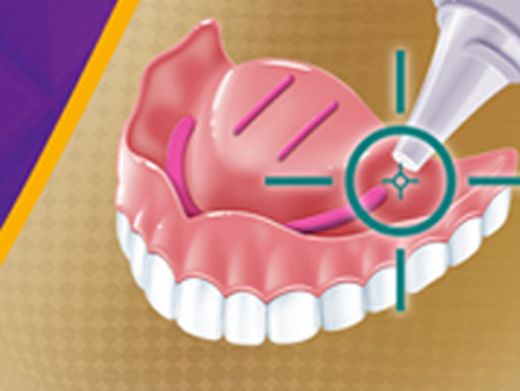 Adhesives for Prosthetics