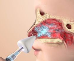 Aluneb Nasal Mist Device