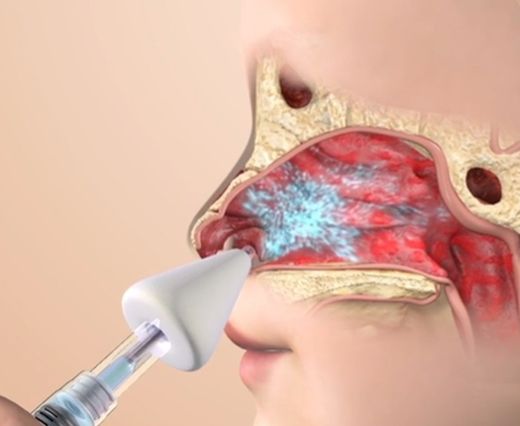Aluneb Nasal Mist Device