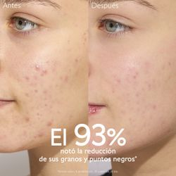 Caudalie Rotina Anti-Imperfeições Pack 4 Produtos