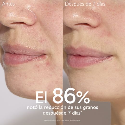 Caudalie Rotina Anti-Imperfeições Pack 4 Produtos