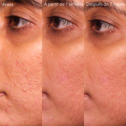 Caudalie Rotina Anti-Imperfeições Pack 4 Produtos