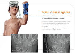 Donjoy Exos Short Arm Fracture Brace 312 with BOA