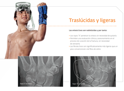 Donjoy Exos Short Arm Fracture Brace 312 with BOA